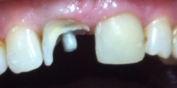 Экстренное восстновление коронковой части обеих центральных зубов - фото №1
