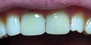 Экстренное восстновление коронковой части обеих центральных зубов - фото №2
