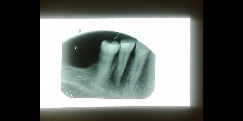 Лечение каналов корня зуба - фото №1