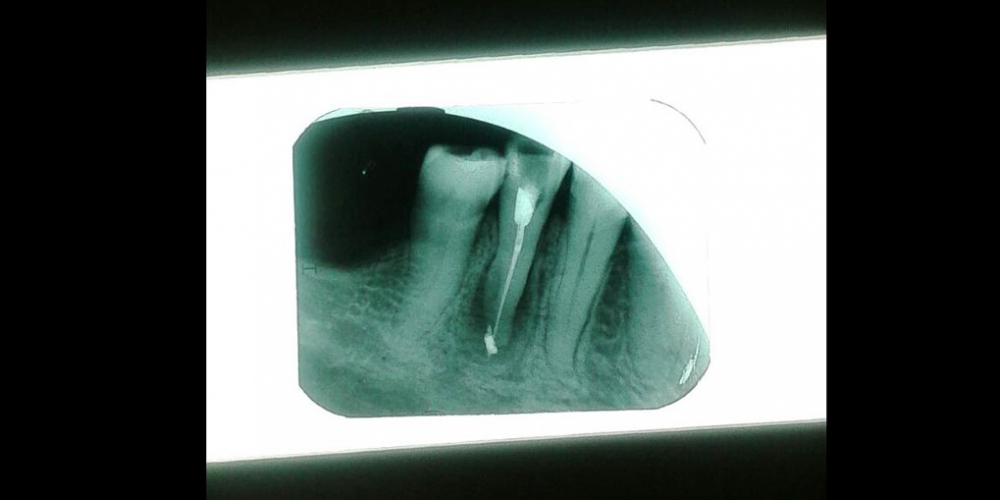 Лечение каналов корня зуба - фото №2