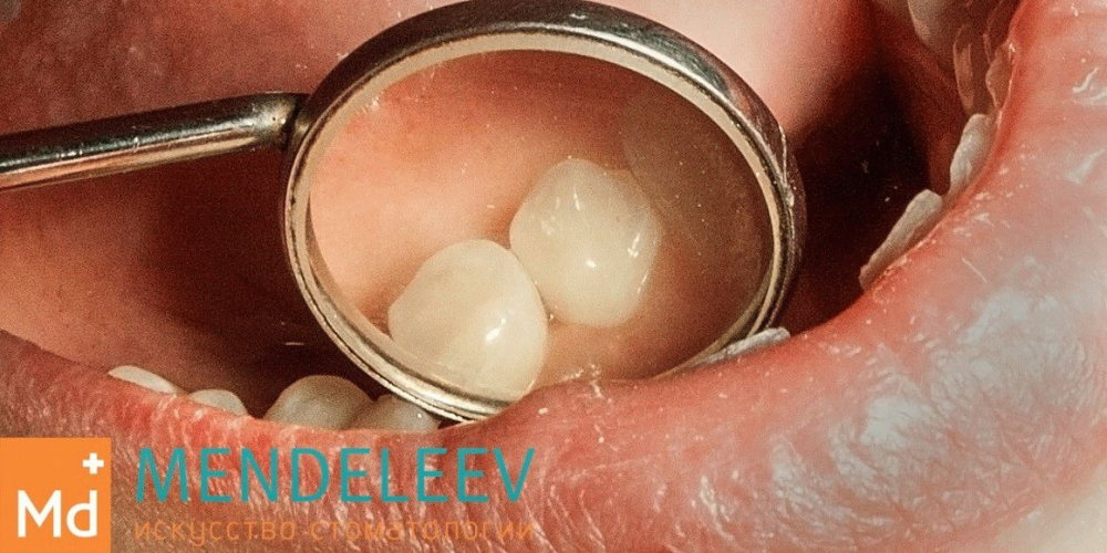 Лечение кариеса зуба 4.4 - фото №2