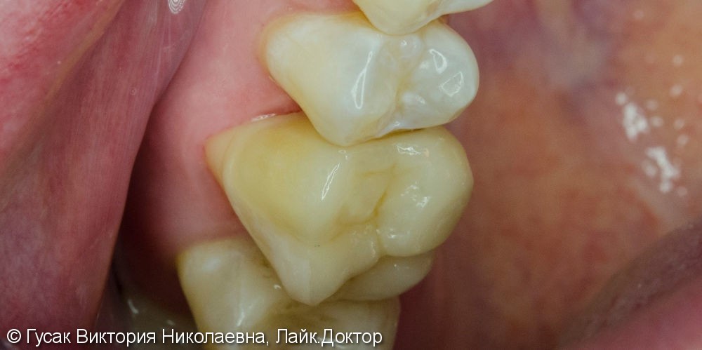 Восстановление зуба керамической вкладкой - фото №2