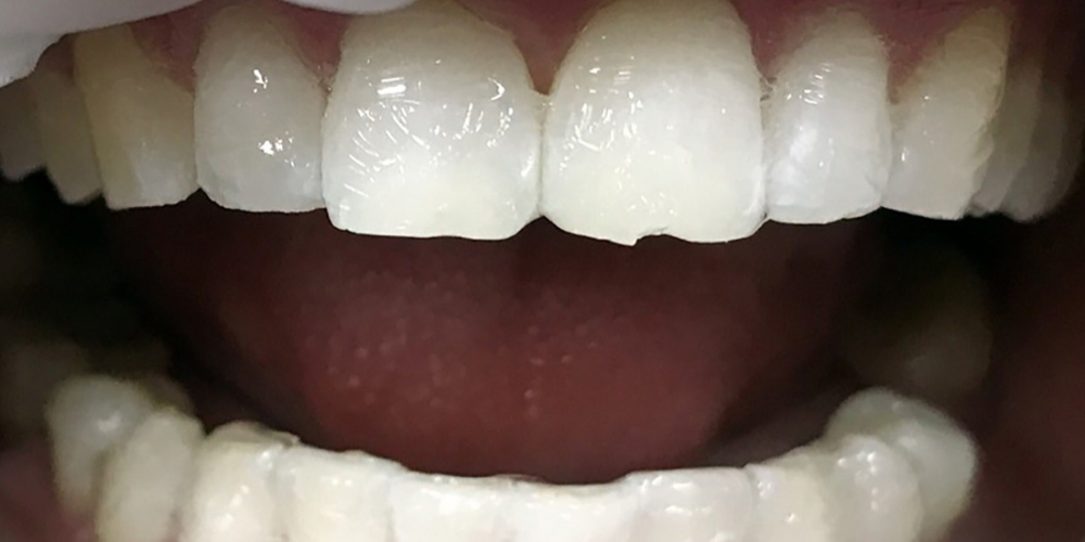 Результат отбеливания зубов системой Зум 3 - фото №2