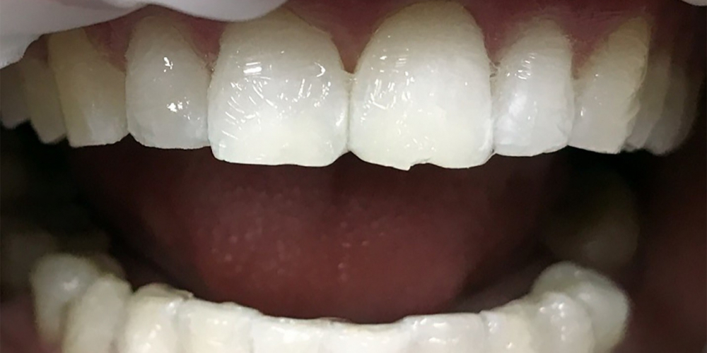 Отбеливание зубов системой ZOOM 3 - фото №2