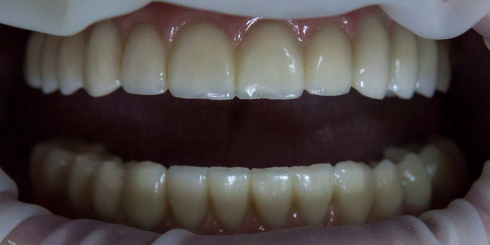 Тотальное протезирование при полном отсутствии зубов - фото №2