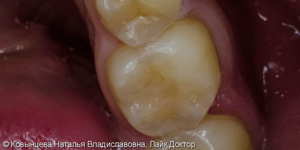 Лечение кариозной полости зуба 3.6 - фото №2