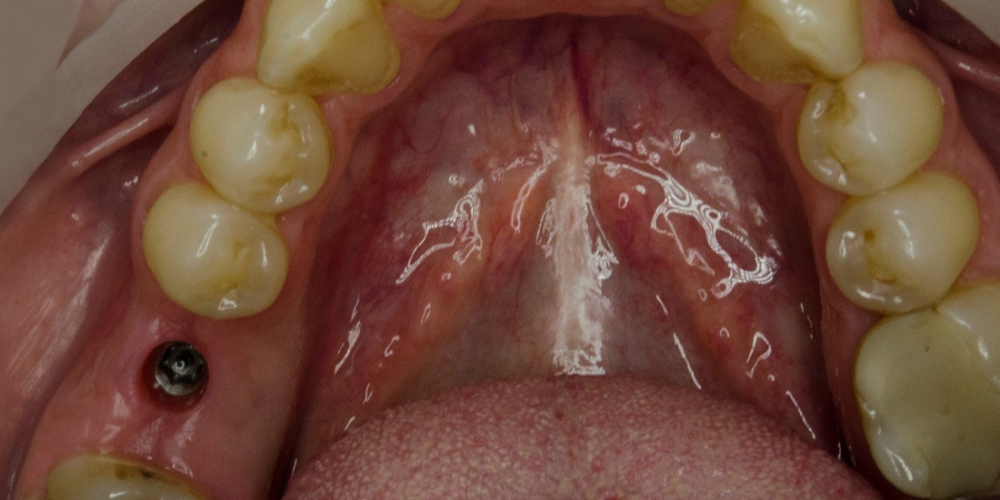 Имплантация Альфа Био одного зуба + металлокерамическая коронка - фото №1