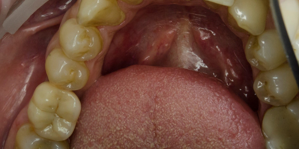 Имплантация Альфа Био одного зуба + металлокерамическая коронка - фото №2