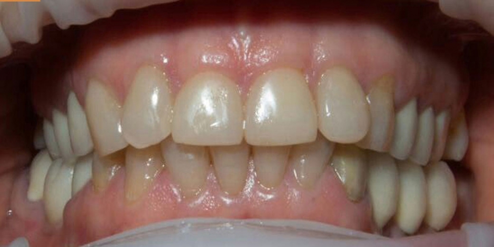 Установка виниров на передние зубы верхней и нижней челюсти - фото №1