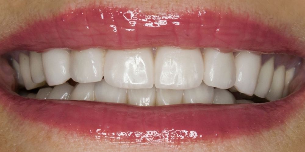 Установка виниров на передние зубы верхней и нижней челюсти - фото №2
