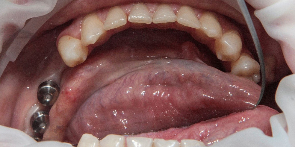 Имплантация и протезирование 3-х зубов из диоксида циркония - фото №1