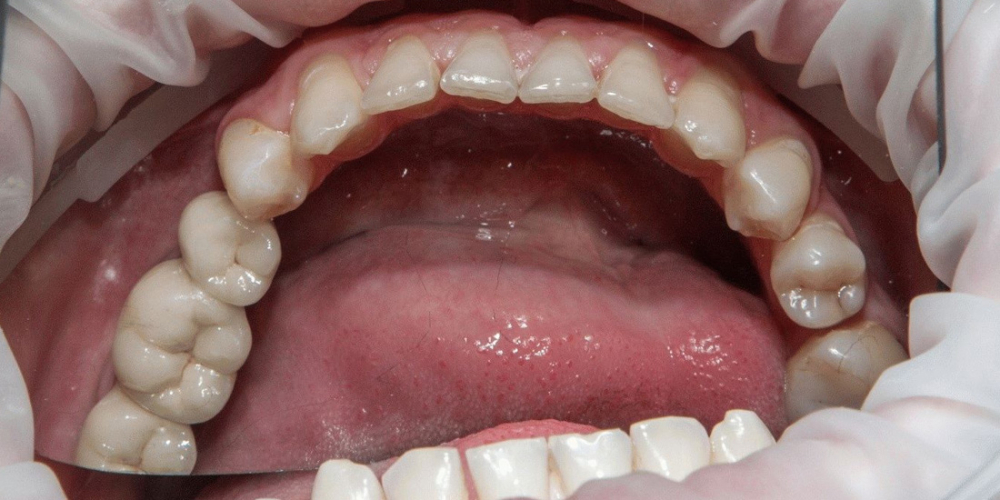 Имплантация и протезирование 3-х зубов из диоксида циркония - фото №2