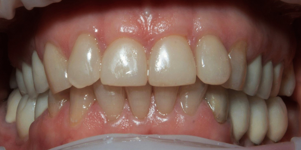 Установка керамических виниров на зубы, пациентке 54 года - фото №1