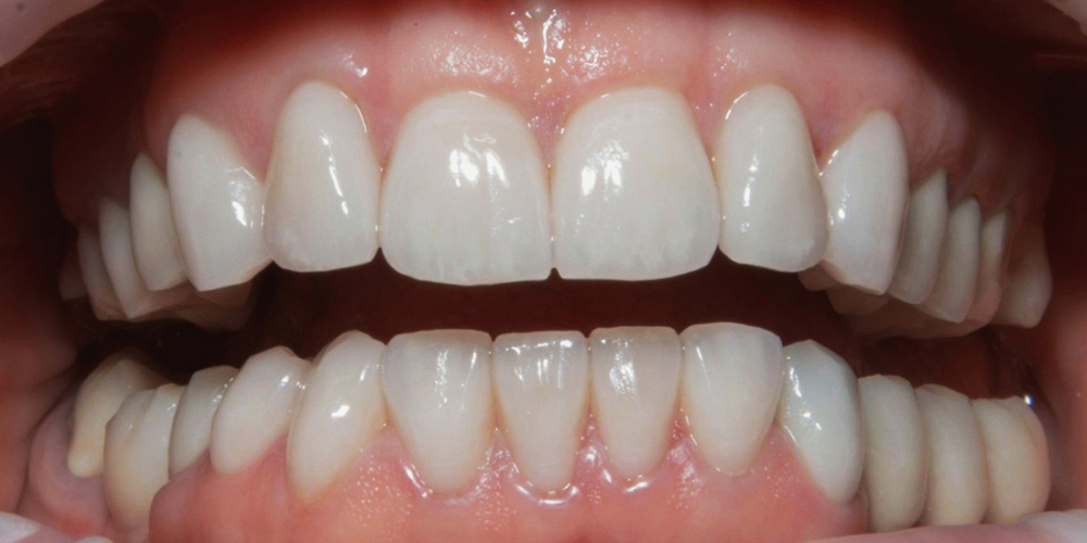 Установка керамических виниров на зубы, пациентке 54 года - фото №2