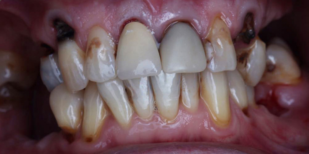 Протезирование зубов на 4 имплантах All-on-4 - фото №1
