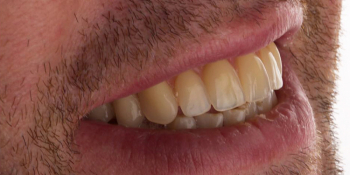 Протезирование зубов на 4 имплантах All-on-4 - фото №2