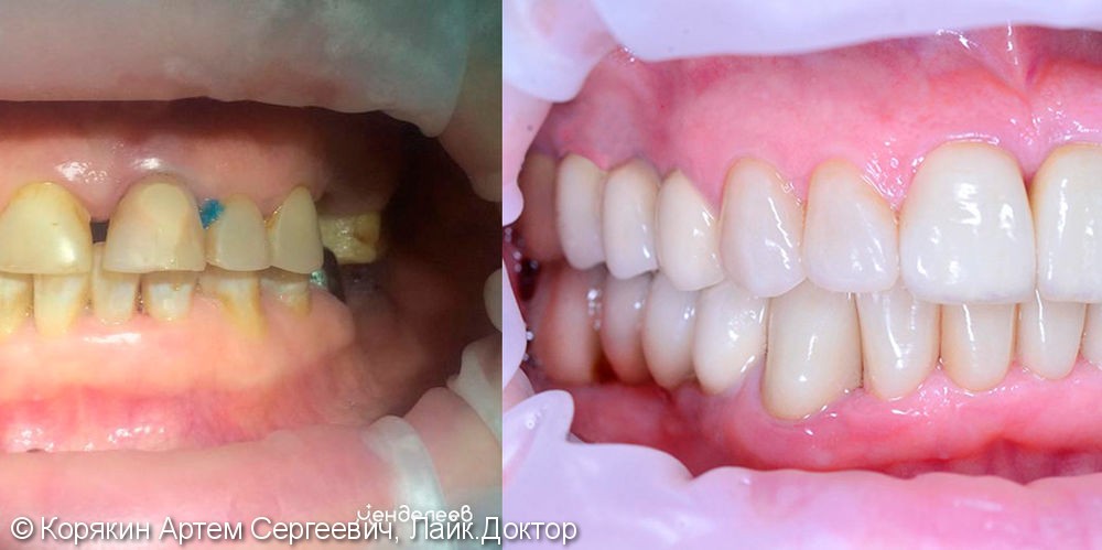 Имплантация зубов и установка керамических коронок E-Max - фото №1