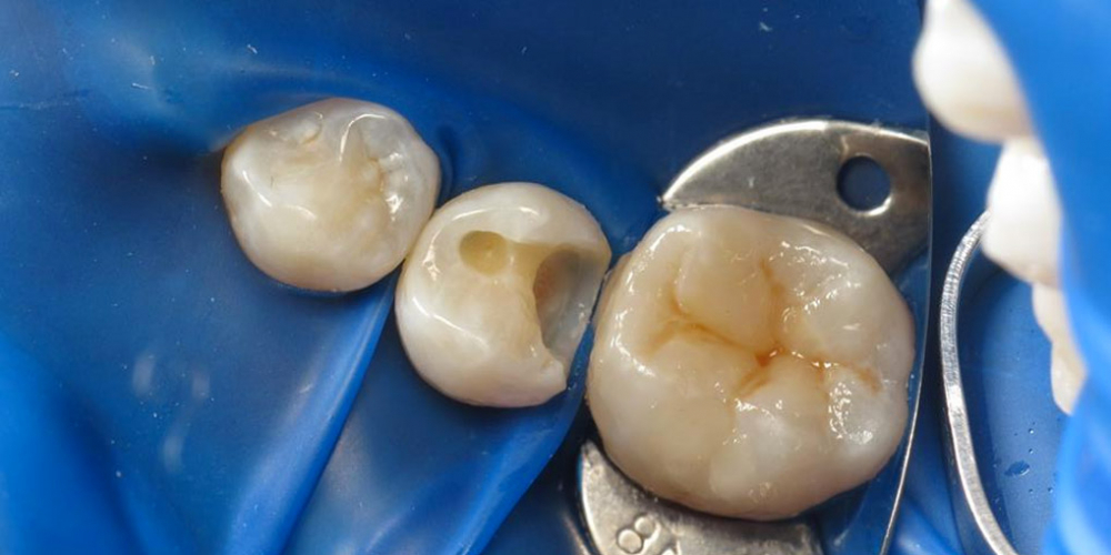 Реставрация двух зубов верхней челюсти - фото №4