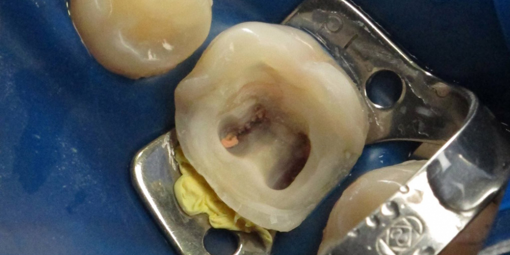 Реставрация разрушенного зуба - фото №1
