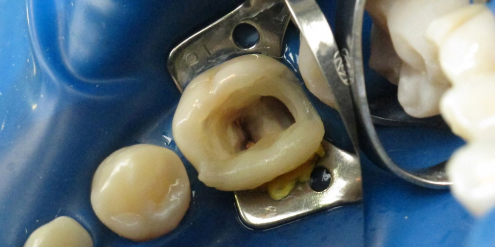 Реставрация разрушенного зуба - фото №3
