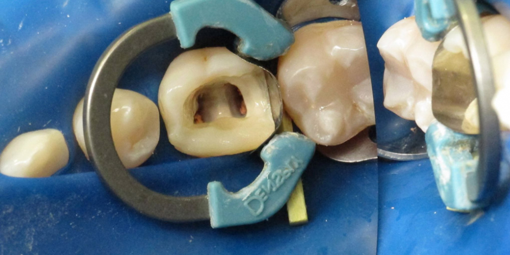 Реставрация разрушенного зуба - фото №4