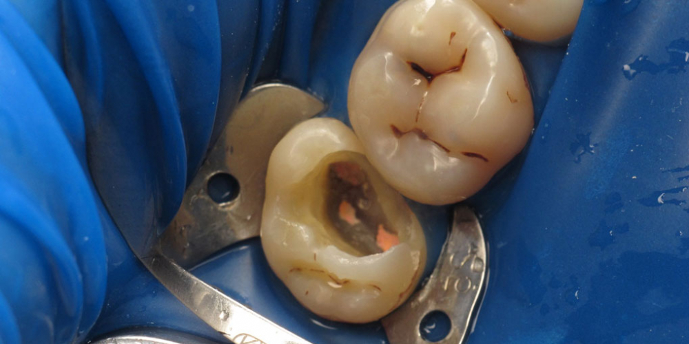 Лечение корневых каналов с последующей художественной реставрацией зуба - фото №1