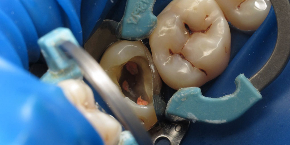 Лечение корневых каналов с последующей художественной реставрацией зуба - фото №3