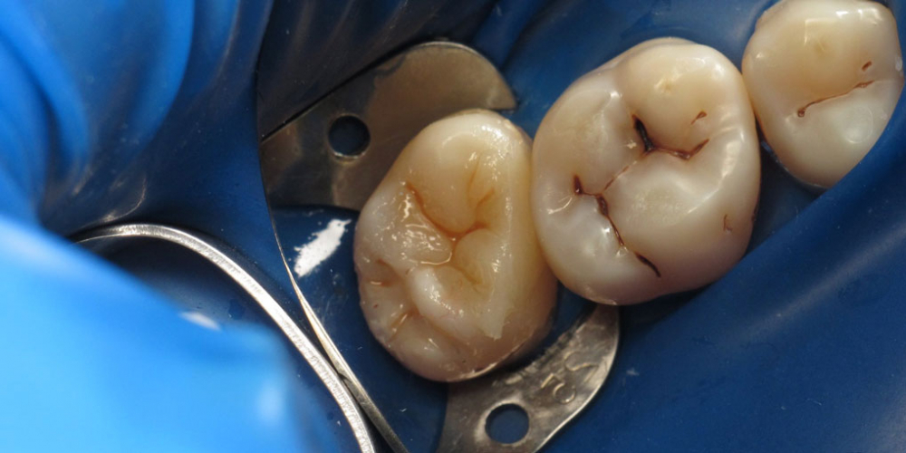 Лечение корневых каналов с последующей художественной реставрацией зуба - фото №2