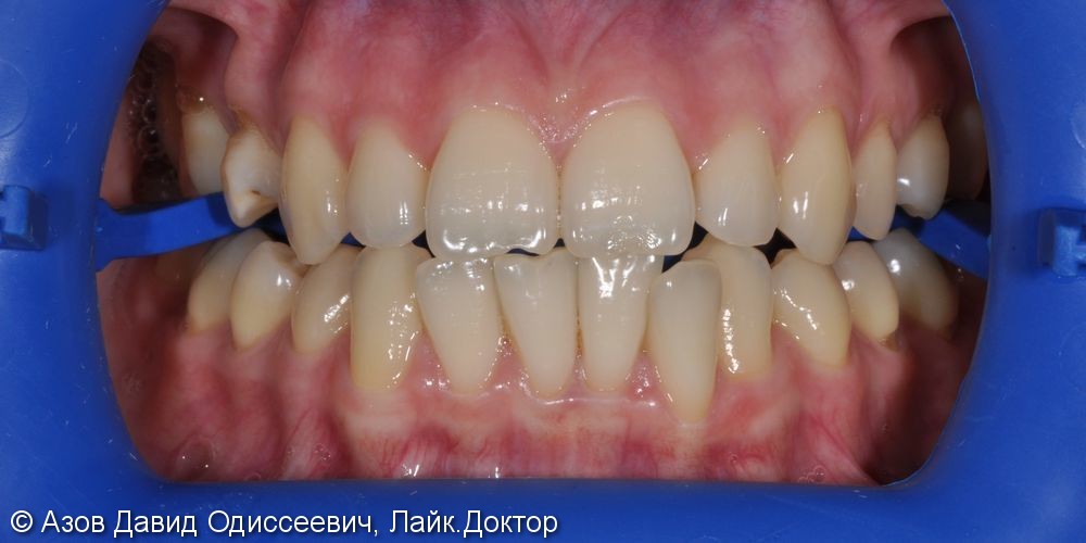 Отбеливание зубов холодным LED светом, до и после - фото №1