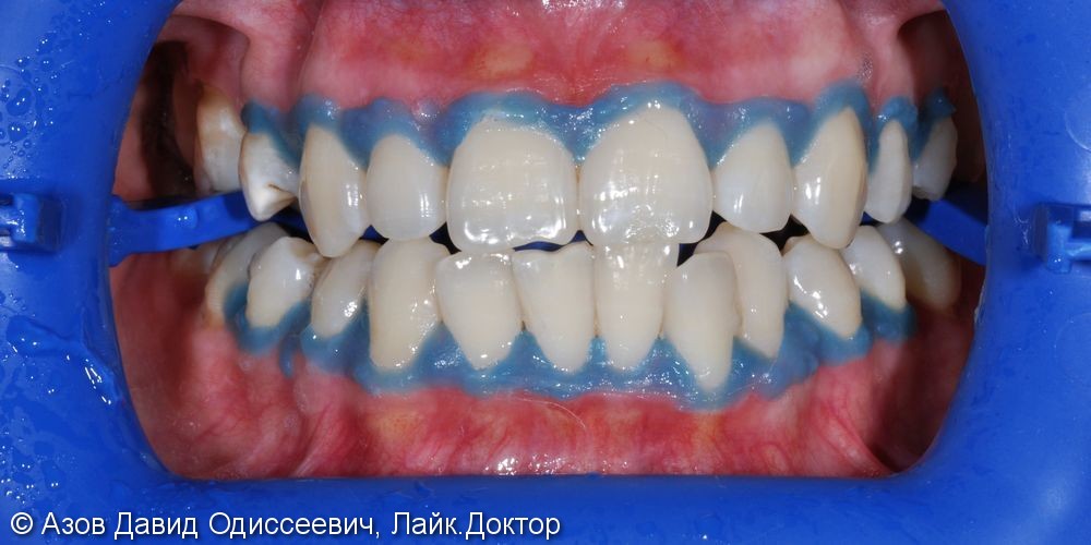 Отбеливание зубов холодным LED светом, до и после - фото №2