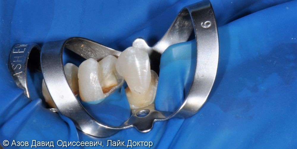 Восстановление больших дефектов зубов без коронок - фото №1