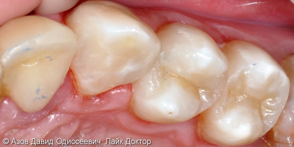 Восстановление больших дефектов зубов без коронок - фото №3