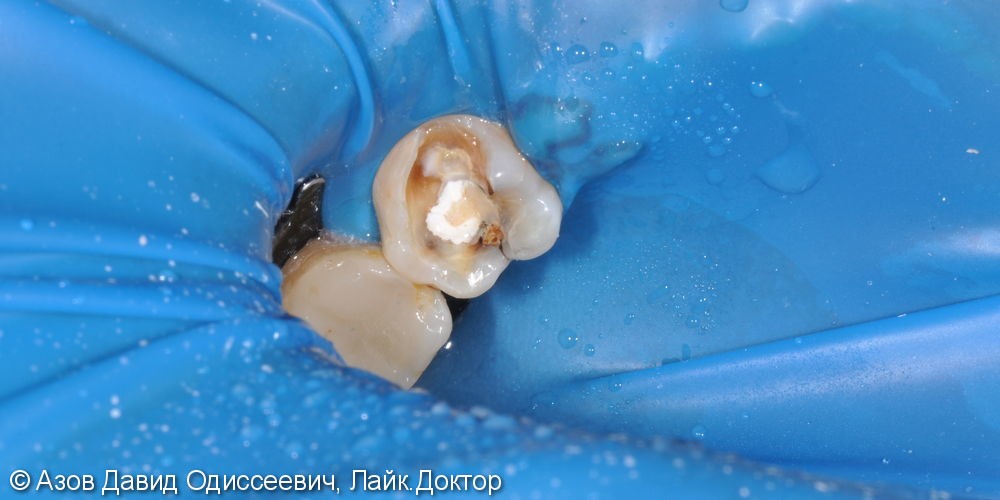 Лечение глубокого кариеса жевательного зуба, результат до и после - фото №1