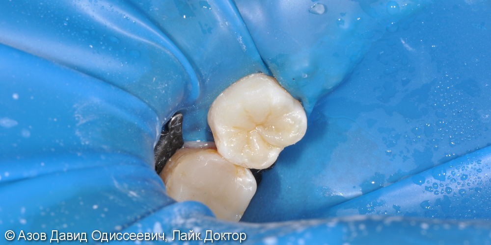 Лечение глубокого кариеса жевательного зуба, результат до и после - фото №2