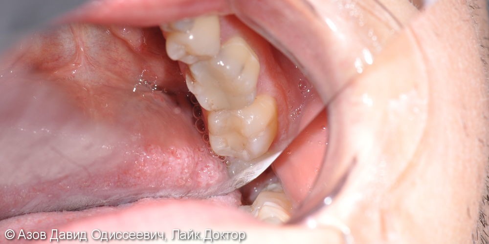Лечение кариеса двух зубов 4.6; 4.7 с помощью реставрации и коронки E.max - фото №1