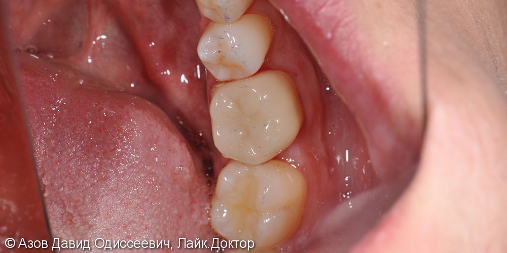 Лечение кариеса двух зубов 4.6; 4.7 с помощью реставрации и коронки E.max - фото №6