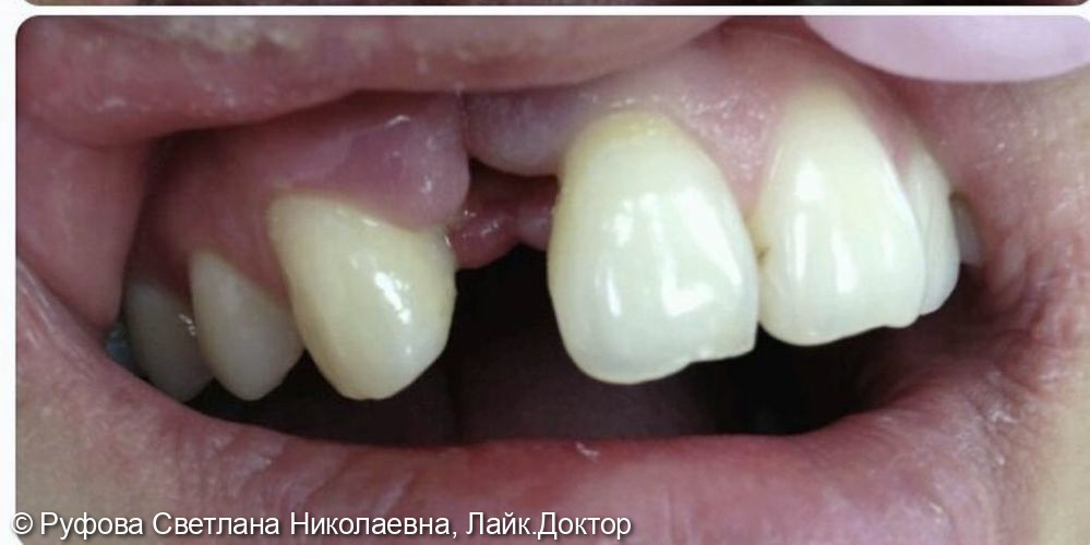 Адгезивное микропротезирование 12 зуба - фото №1
