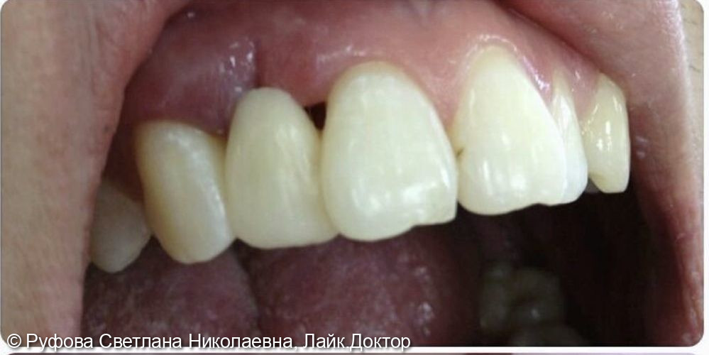 Адгезивное микропротезирование 12 зуба - фото №2