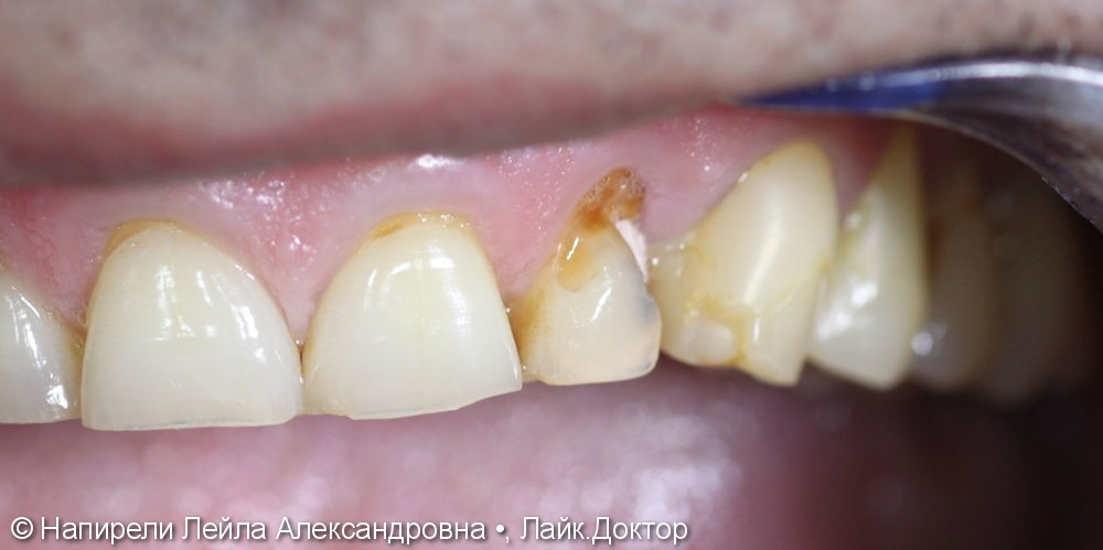 Эстетическая реставрация 22 зуба, до и после - фото №1