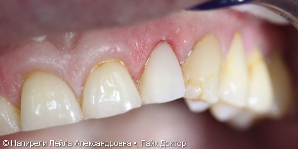 Эстетическая реставрация 22 зуба, до и после - фото №2