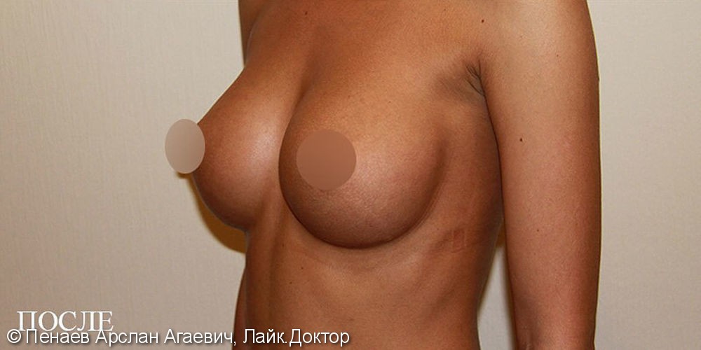 Увеличение груди высокопрофильными имплантами 295 MX Natrelle 410 Allergan - фото №2