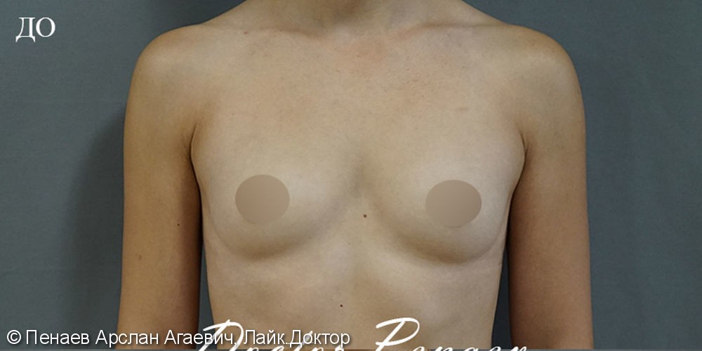Результат увеличения груди имплантами - фото №1