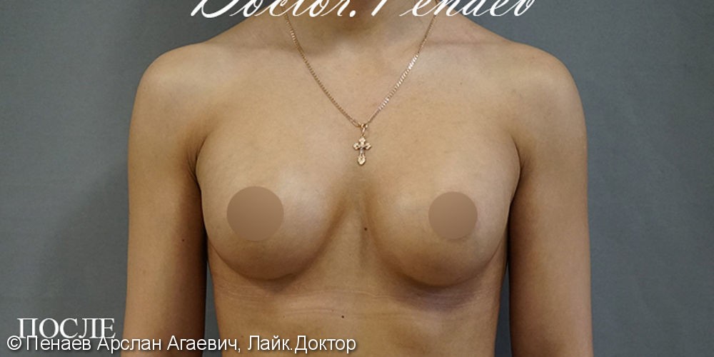 Результат увеличения груди имплантами - фото №2