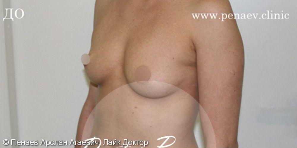 Увеличение груди имплантами на 2 размера, до и после - фото №1