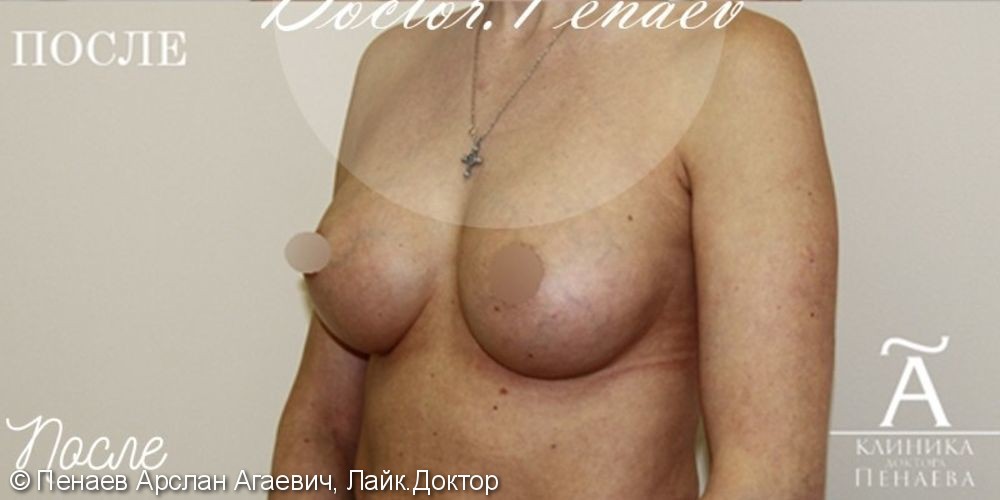 Увеличение груди имплантами на 2 размера, до и после - фото №2