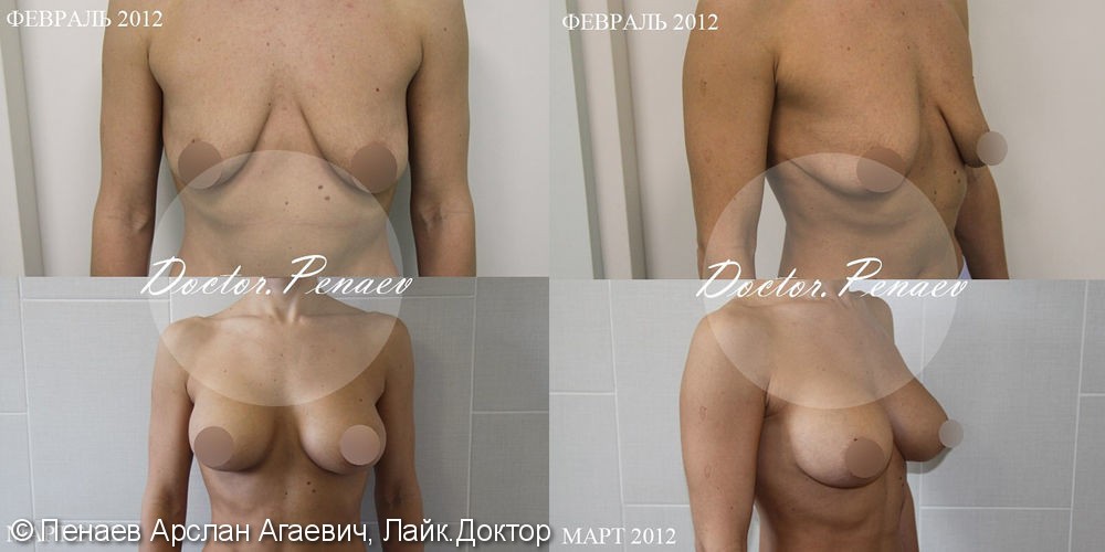 Протезирование и липотрансфер груди, липосакция брюшной стенки с гравировкой - фото №1