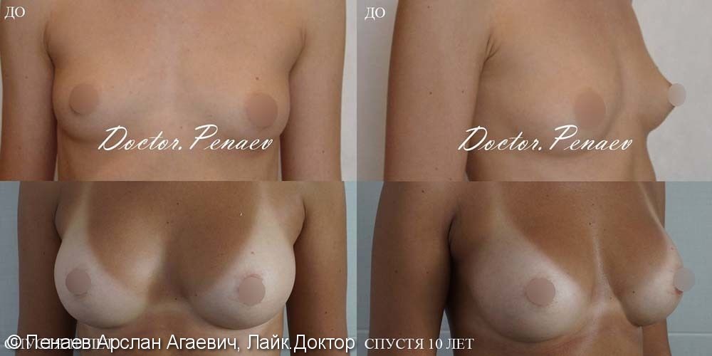 Протезирование груди имплантами 255 MX Natrelle 410 Allergan - фото №1