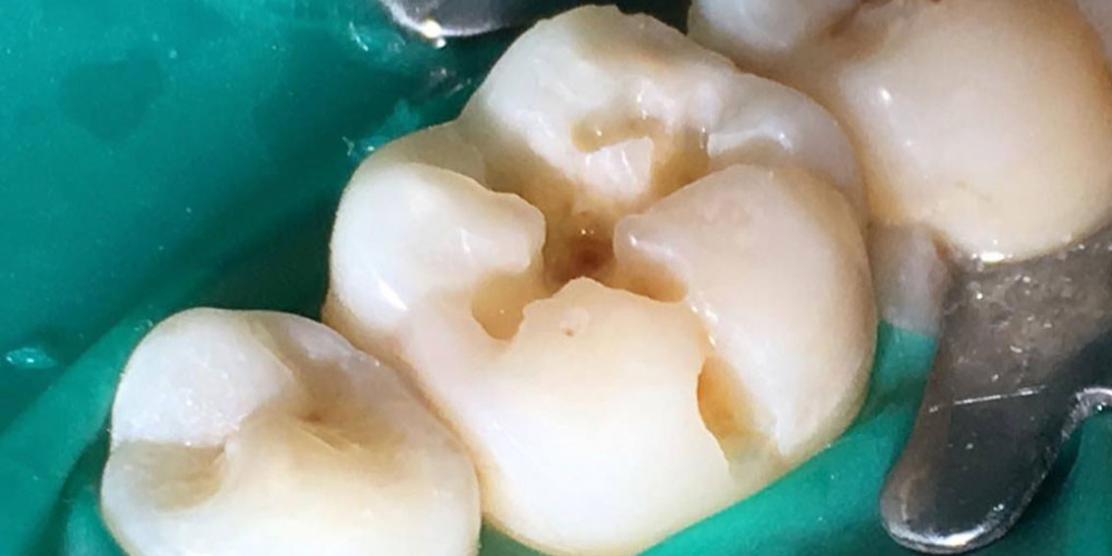 Результат лечения кариеса жевательного зуба - фото №1