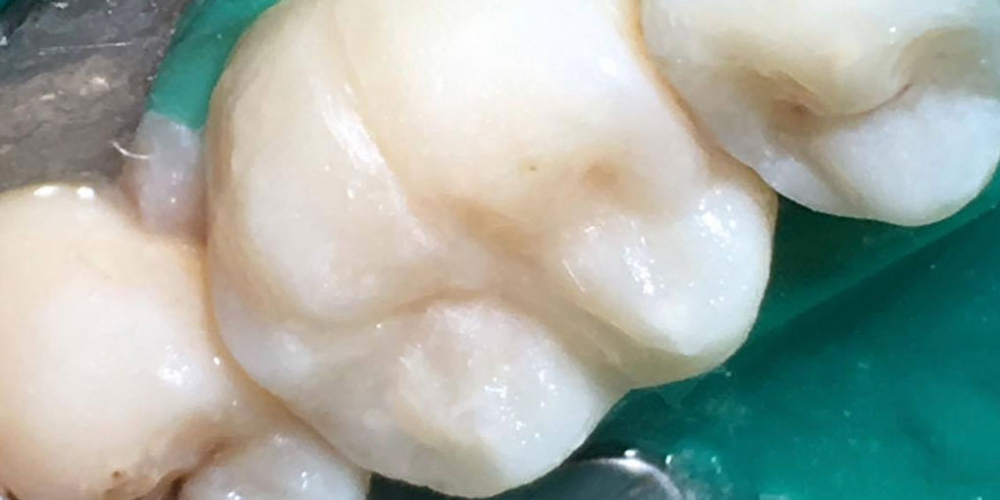 Результат лечения кариеса жевательного зуба - фото №4