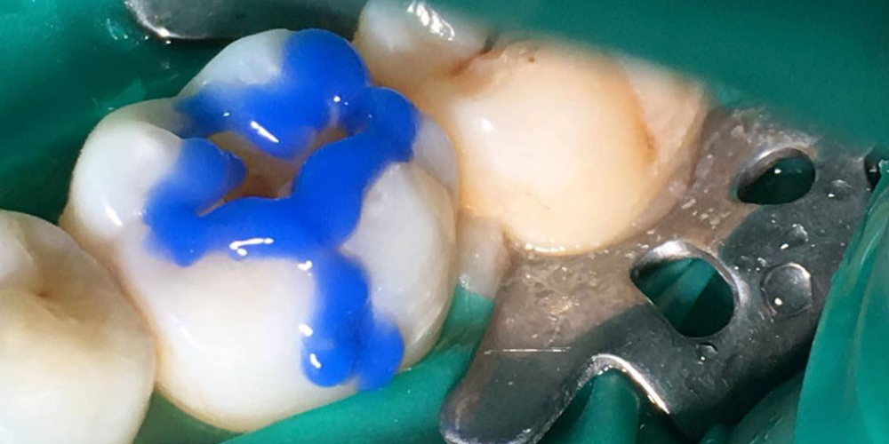 Результат лечения кариеса жевательного зуба - фото №3